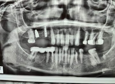 DENTZ3ZJQ4KU_smile_Dental_care__dr_ravi_kumar_BDS_MDS____ex-resident_TMH_mumbai__ChIJg_5G1Uwf8jkRvurApF3LqgU_8